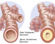 Миниатюра к статье Бронхиальная астма: лечение и препараты