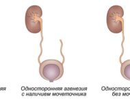 Миниатюра к статье Агенезия почки – приговор?