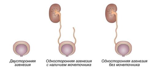 Миниатюра к статье Агенезия почки – приговор?