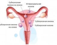 Миниатюра к статье Чем опасна миома для жизни женщины?