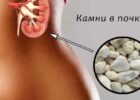 Миниатюра к статье Как растворить камни в почках в домашних условиях