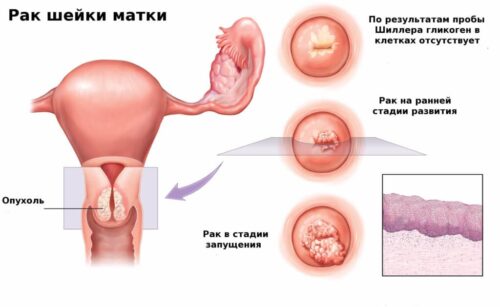 Миниатюра к статье Рак шейки матки