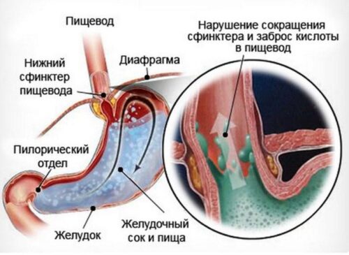 Миниатюра к статье Эзофагит пищевода – есть ли риск заболеть и как с ним бороться?