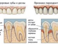 Миниатюра к статье Лечение десен: причины, симптомы и народные методы лечения